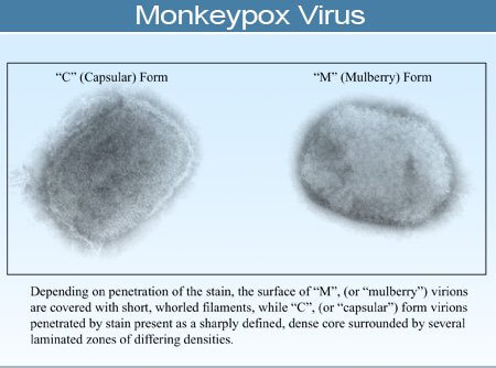 Monkeypox Facts, Symptoms, Causes & Treatment